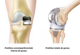 Comprendre les différentes types de prothèses de genou : Quelle est la meilleure option pour vous ?
